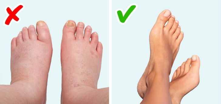 Swollen toes