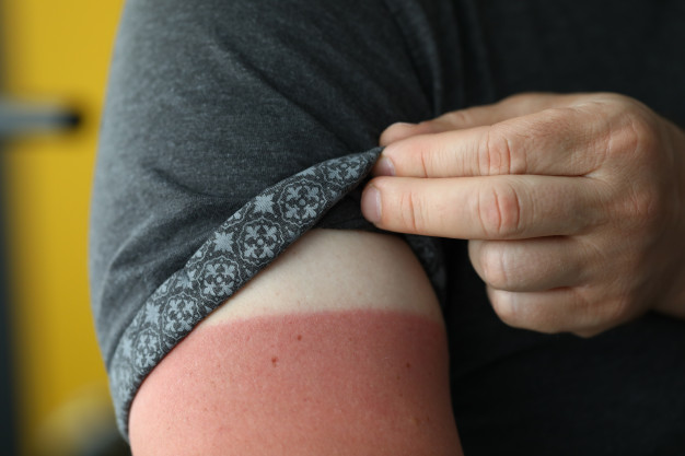 Male hand with a severe sunburn