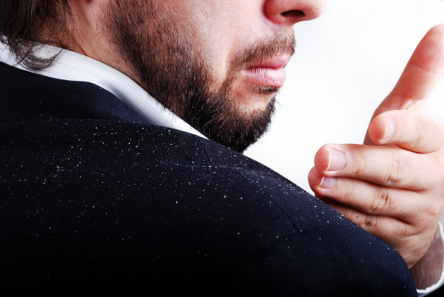 dandruff-issue-man-s-sholder
