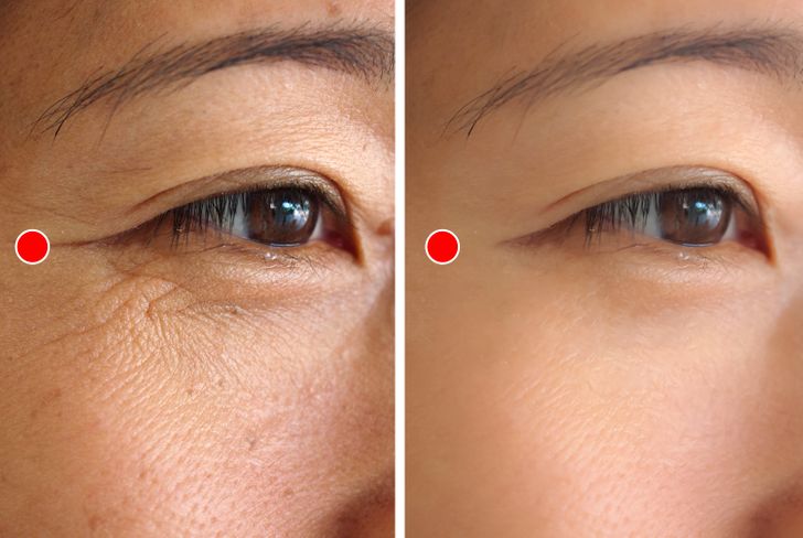 How to get rid of “crow’s feet”
