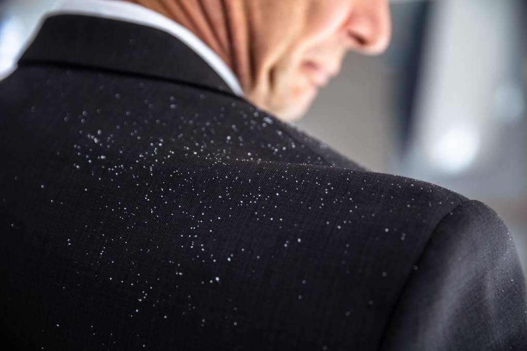  Dandruff 