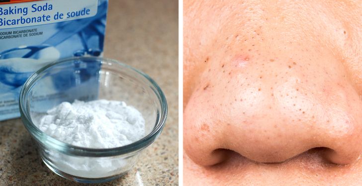 Natural blackhead remover