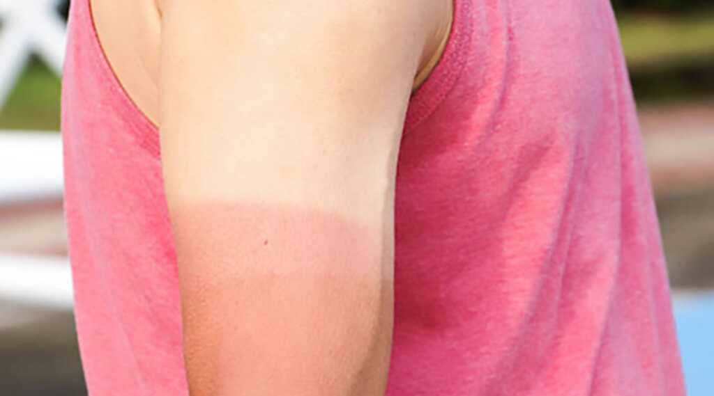 man sunburnt