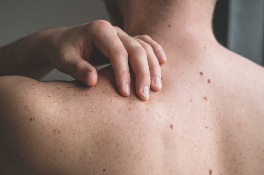 skin cancer