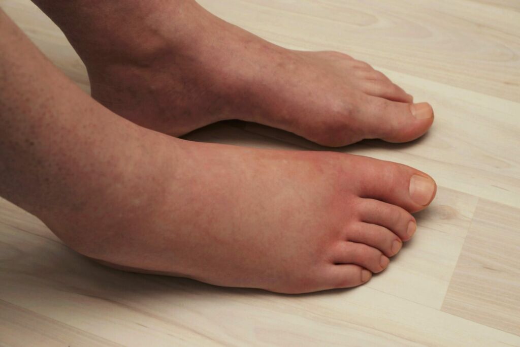 ankles and feet are swollen 