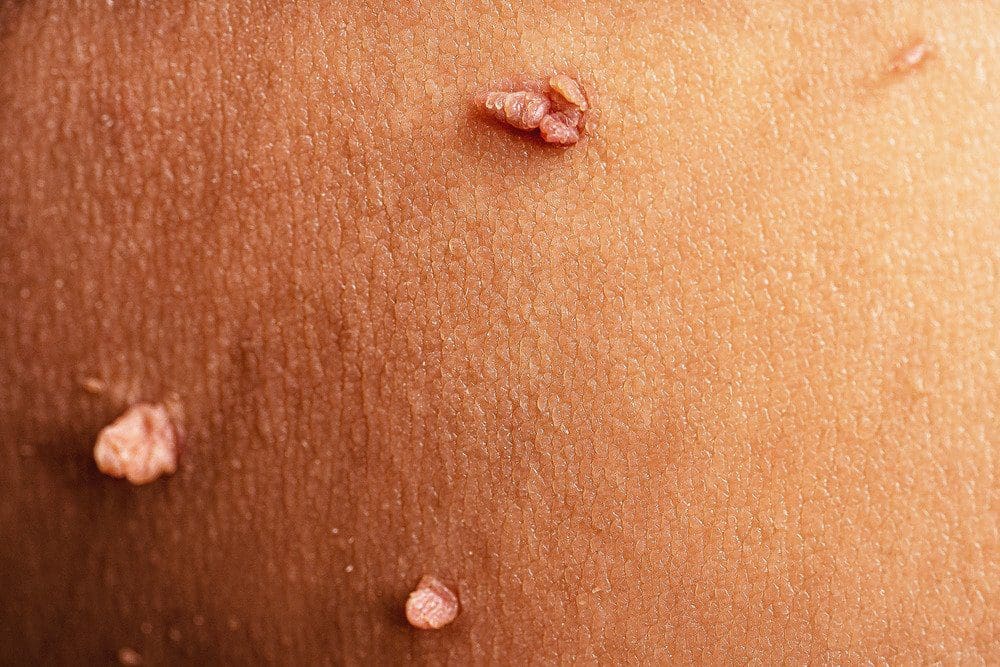 genital warts