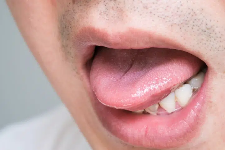 syphilis