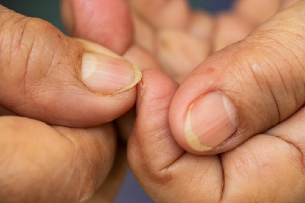 yellow nail syndrome