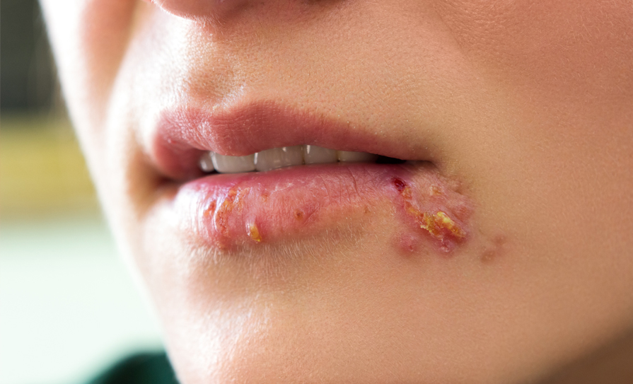 herpes